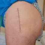 Hip Operation Scars
